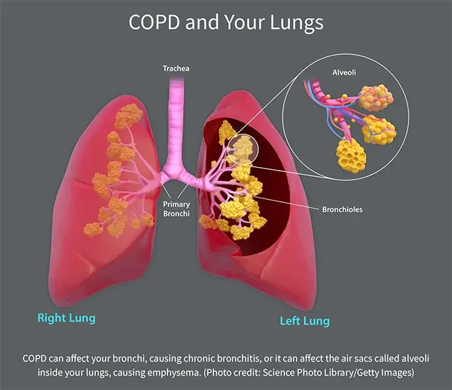 COPD (Chronic Obstructive Pulmonary Disease)