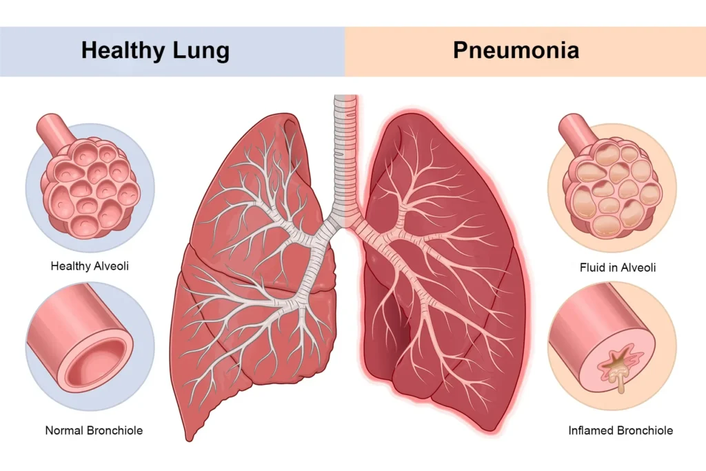 Pneumonia: What to Know