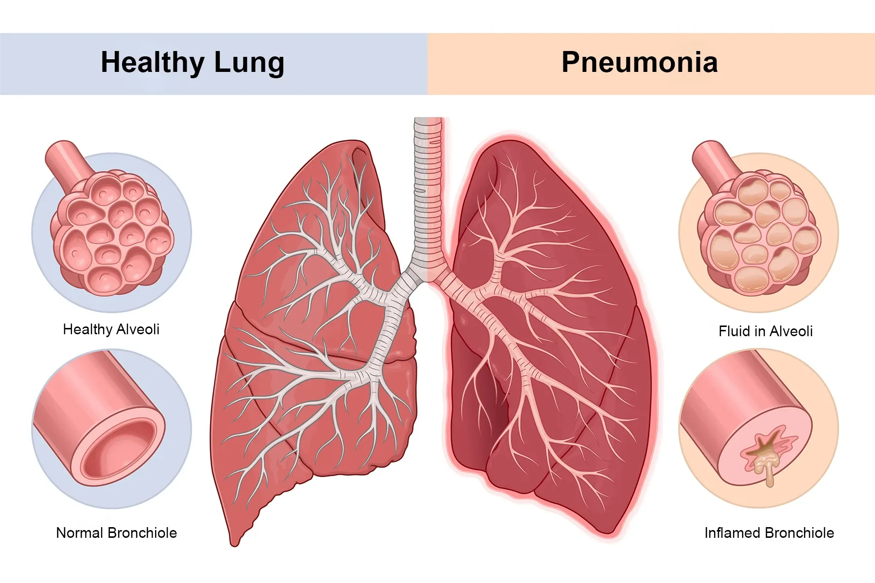 Pneumonia: What to Know