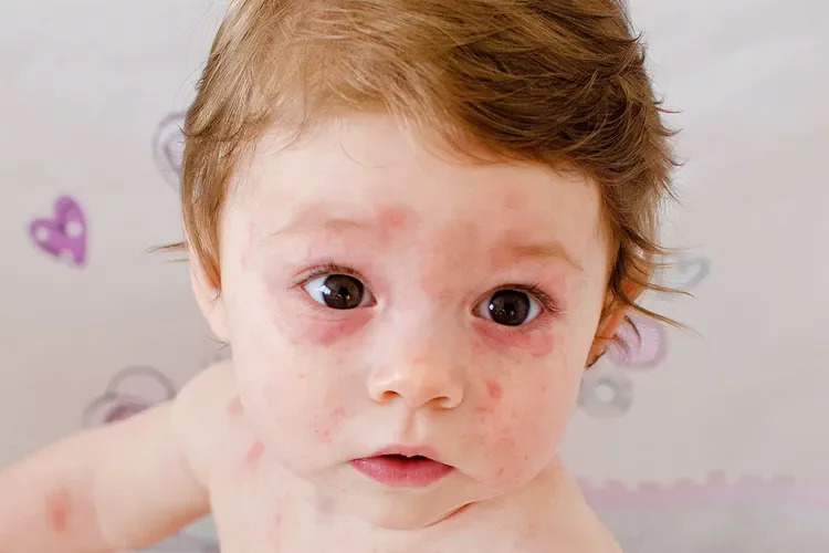 What Is Roseola?