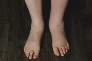 Lymphedema: What to Know