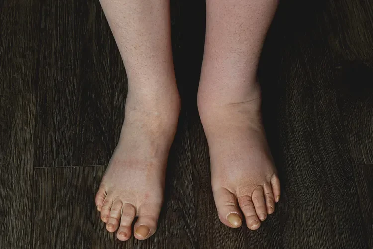 Lymphedema: What to Know
