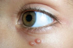 Molluscum Contagiosum