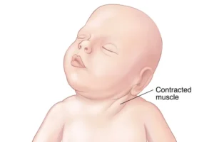 What Is Torticollis?