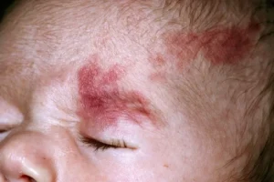 Port-Wine Stain Birthmarks