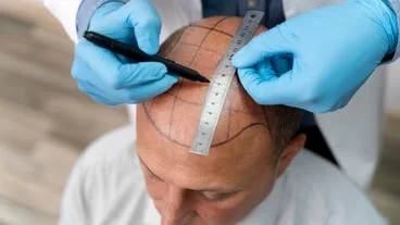 Exploring hair transplant clinics in Turkey